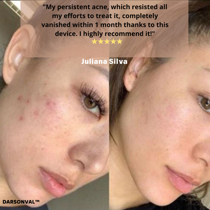 DARSONVAL™ Skin Therapy Machine